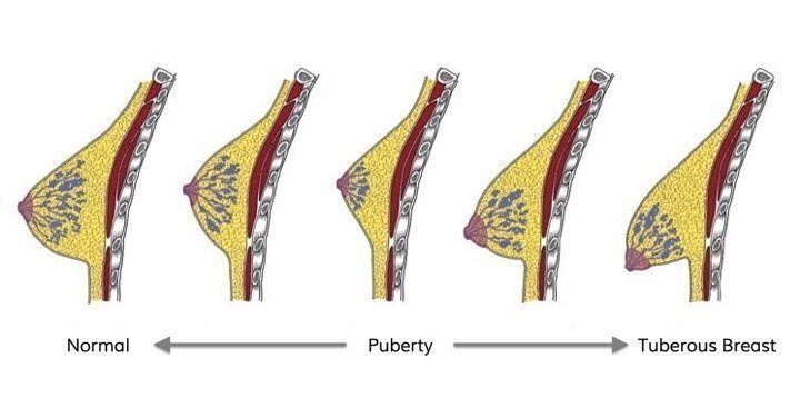 illustration of tubular breast deformity