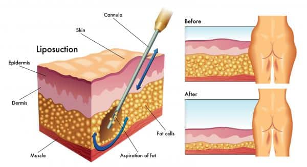 up close cross section of fat underneath skin being removed by liposuction
