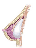 To find out your breast implant options after capsular contracture, which is NOT shown in this illustration, please call Board Certified Knoxville Plastic Surgeon Dr. Dean Kleto.