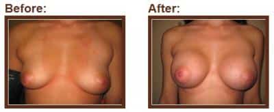 breast augmentation 0 1