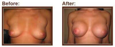 woman’s bare chest before and after breast augmentation, breasts larger after procedure