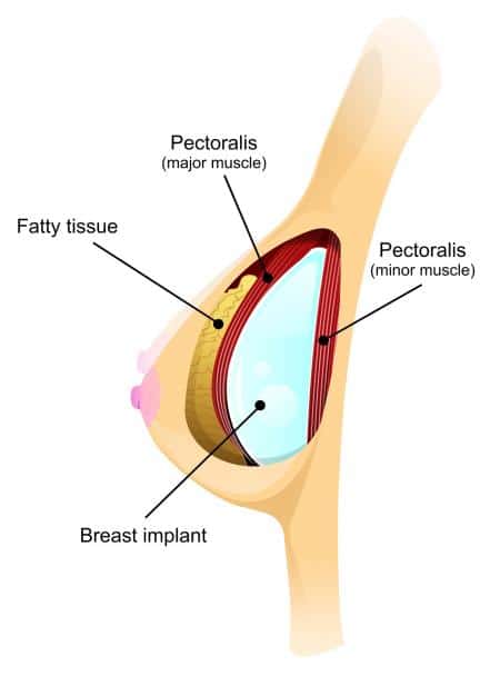breast implant diagram illustration 0