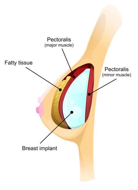 illustrated cross section of breast with breast implant inside