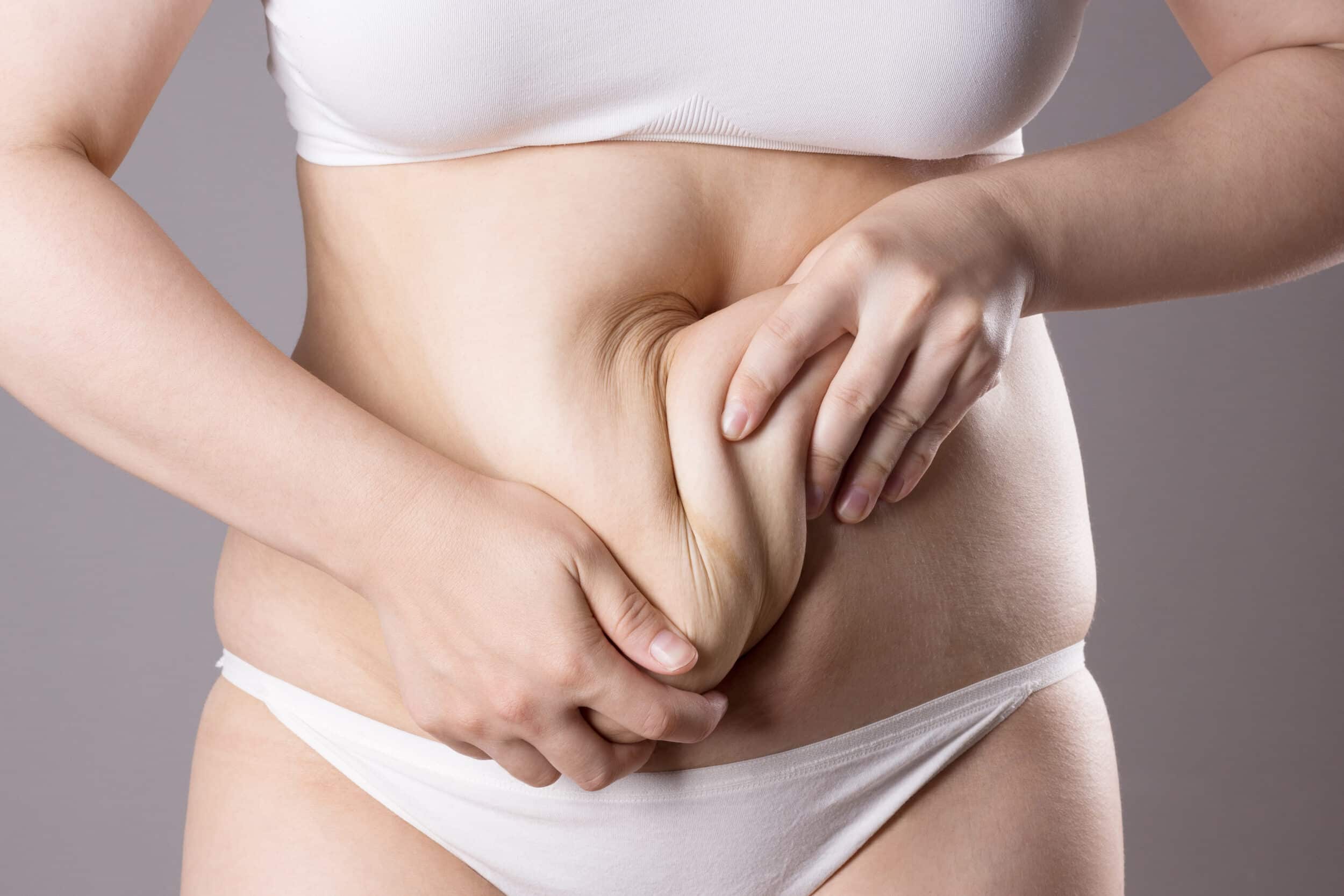 Close up of a woman squeezing the loose skin on her stomach after pregnancy, in need of a tummy tuck