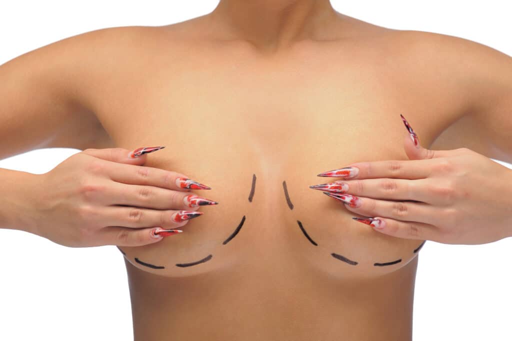 Woman with dotted lines drawn on her chest before breast reduction surgery with her hands covering her nipples