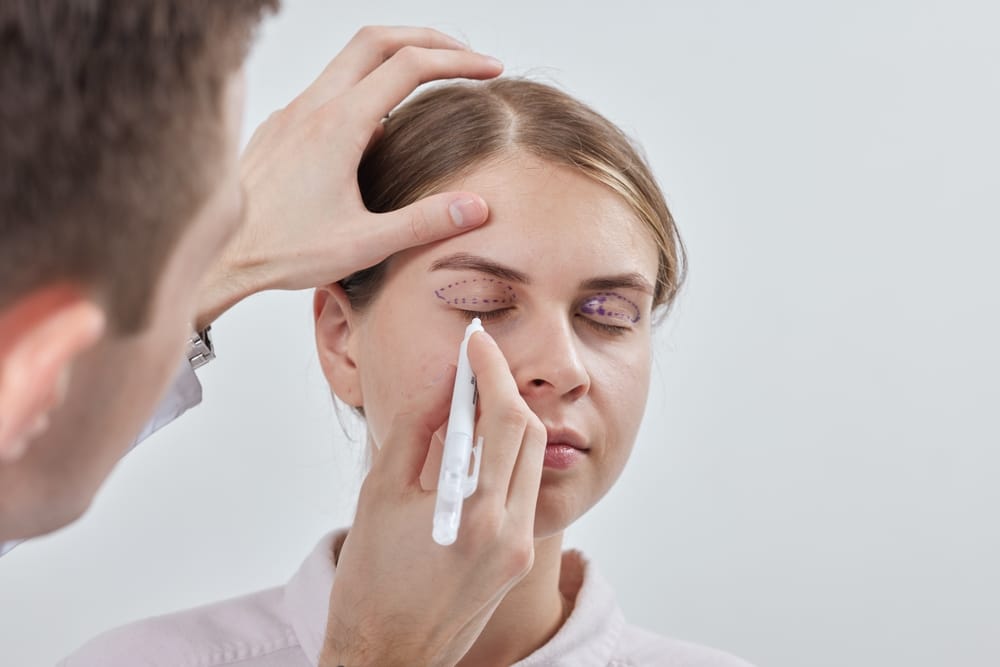 Woman having her eyelids drawn on by her surgeon in preparation for her eyelid surgery, or blepharoplasty.