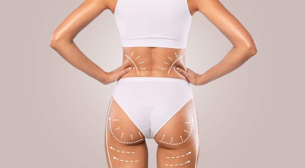 Close up of a woman's body from behind with lines on her body to show where her liposuction treatment was